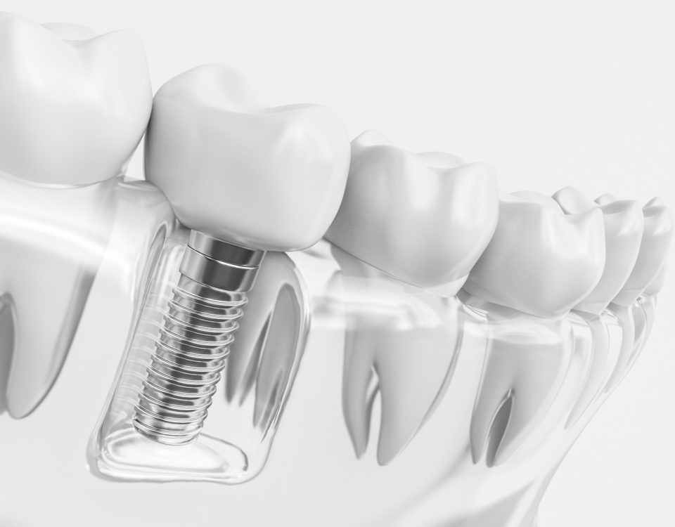 Korony cyrkonowe na implantach Toruń